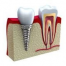 Implantul dentar pentru zambet perfect