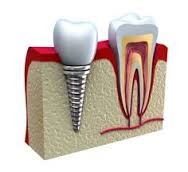 Noutati nunti: Implantul dentar pentru zambet perfect