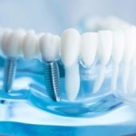 Implantul dentar pentru zambet perfect