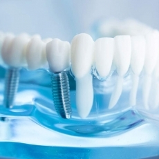 implanturi dentare bucuresti