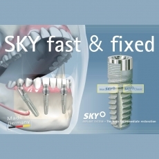 implant dentar fast and fixed